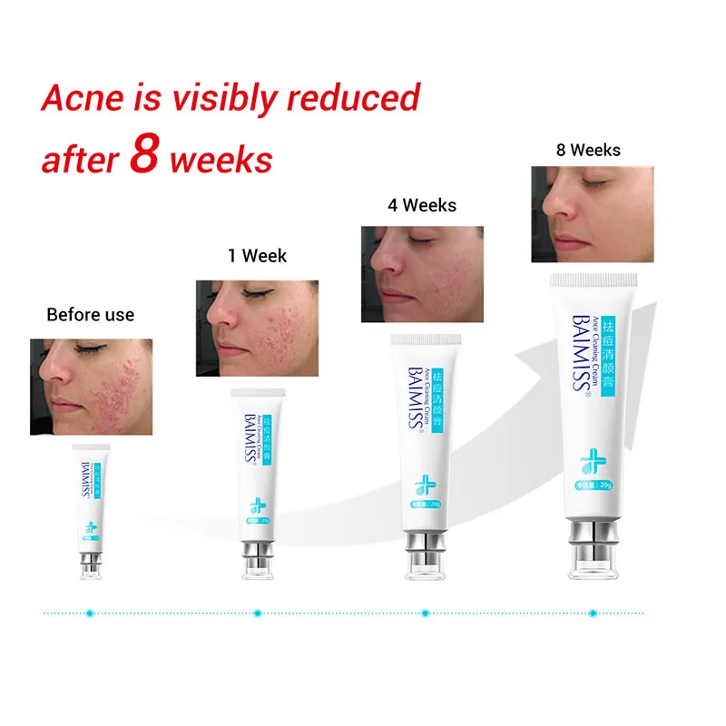 Lasting Oil-control Shrinking Pores Anti-inflammatory Anti-acne Face Cream Effective Acne Cleaning Cream