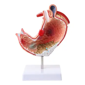 

Human Anatomical Anatomy Stomach Medical Model Gastric Pathology Gastritis Ulcer Medical Teaching Learning Tool