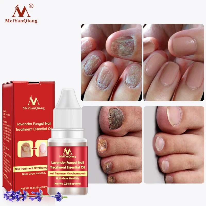 

MeiYanQiong Nail Repair Essence Oil Anti-Fungal Nail Infection Hands/Feet Nail Care Promotes 10ml Anti Infection Paronychia