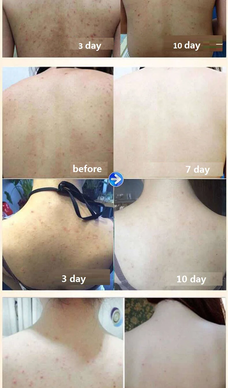 Hand Washing Chinese Soap Whitening Acne Control Oil Sulfur Hotel Soap Soap Pregnant Women Fruit Soap Bar Soap Melanin