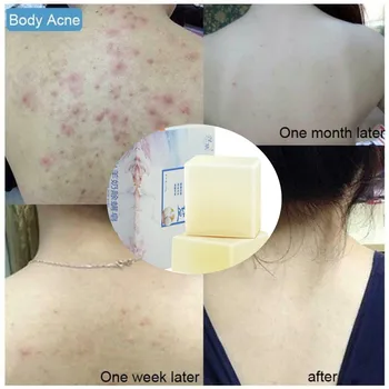 

Soap Cleaner Removal Pimple Pores Acne Treatment Goat Milk Pimple Acne Removal Oil Control And Moisturizing Skin Care 100g #ZF