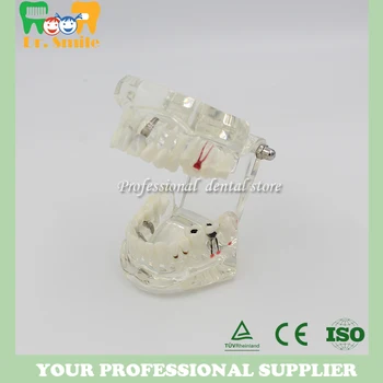 

Removable Dental Implant Disease Teaching Teeth Model & Restoration Bridge Tooth