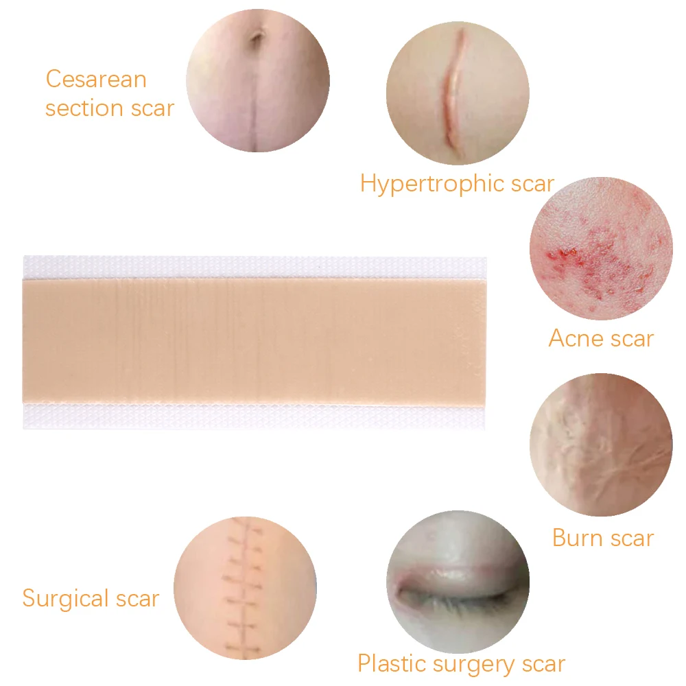 Silicone Scar Patch Sheets Remove Trauma Burn Scar Sheet Skin Repair Removal Therapy Patches Silicone Acne Treatment