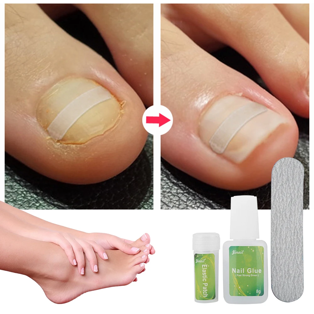 12/24pcs Nail Pedicure Elastic Patches With Nail Glue Ingrown Physical Toenail Correction Tool Clip Brace Bunion Corrector