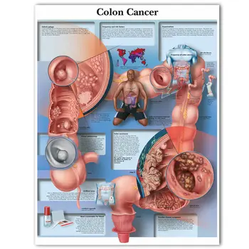 콜론 암 차트 포스터 인쇄 캔버스 회화 벽 사진 의료 교육 의사 사무실 교실
