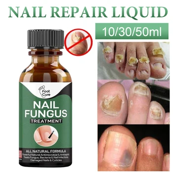 

Nail Repair Essence Liquid Foot Fungal Treatment Removal Gel Anti Infection Paronychia Onychomycosis Skin Care Healthy Products