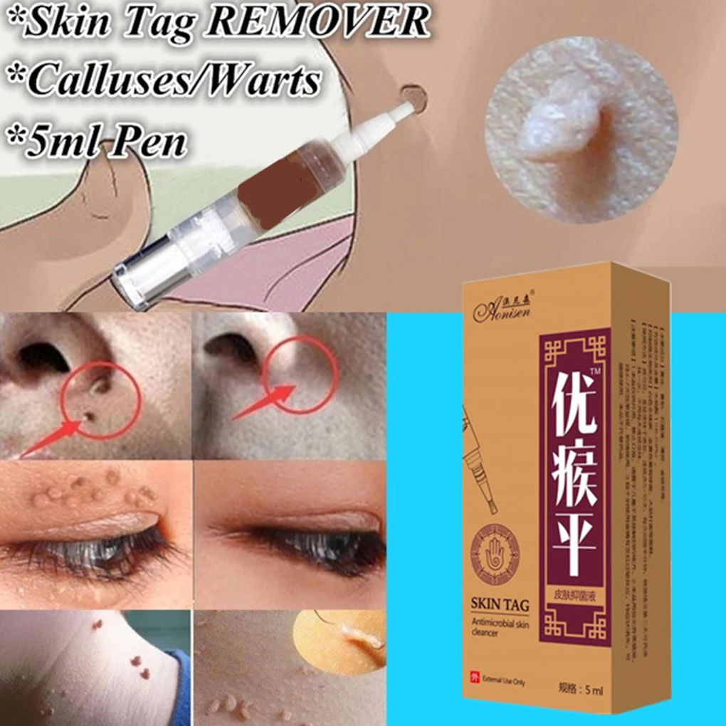 

1 Box Body Warts Removal Cream Skin Tag Remover Foot Corn Calluses Removal Pen Foot Care 5ML