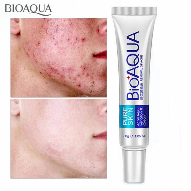 bioaqua removal of acne
