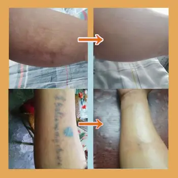 

Invisible Tattoo Patch Scar Flaw Concealing Tapes Sticker Tattoo Acne Cover Up Compression Ultra Thin Skin Invisible Cover