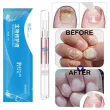 3g средство для ремонта грибка для ногтей продукт Onychomycosis Paronychia противогрибковые инфекция ногтей китайская травяная ручка для ухода за ногтями