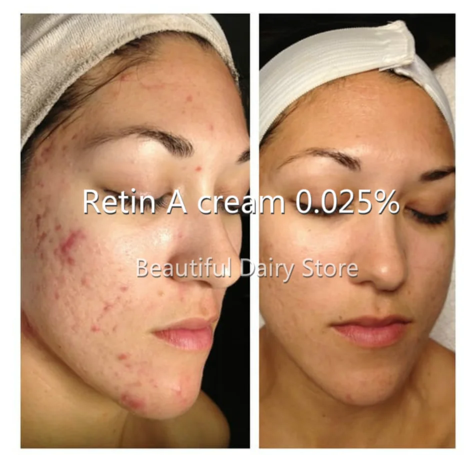 新しいレチノールビタミンa 0 025 クリームゲルレチンにきび抗しわ傷治療10グラム送料無料 顔用セルフタナー ブロンザー Aliexpress