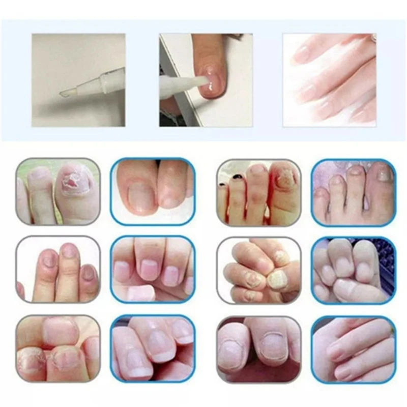 Антигрибковое лечение эффективное лечение грибка пальцев ног антибактериальное средство для ухода за ногтями