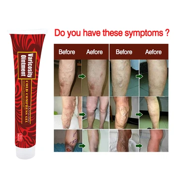 

Health Foot Care Varicose Vein Treatment Cream Effective cure Vasculitis Phlebitis Spider Vein Pain Varicosity Angiitis Ointment