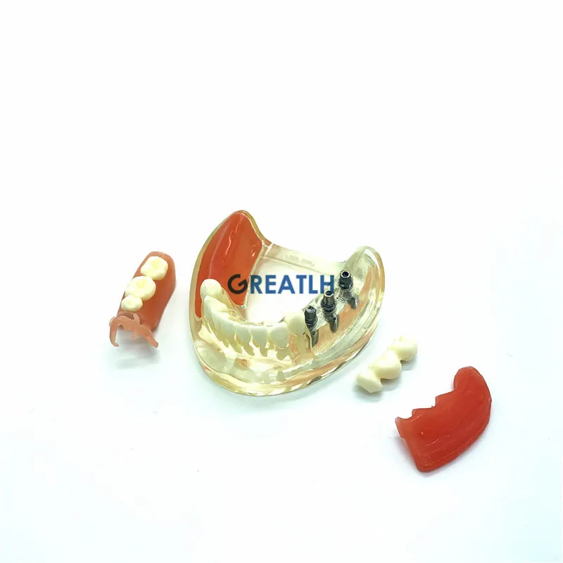 

Dental Implant Restoration Teeth Model Removable Bridge Demonstration Model Teeth dental teaching study learning model