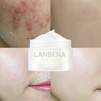 

LANBENA Removal Acne Treatment Snail Repair Whitening Face Cream Anti Wrinkle Anti Aging Pores Relieve Dryness Skin Care