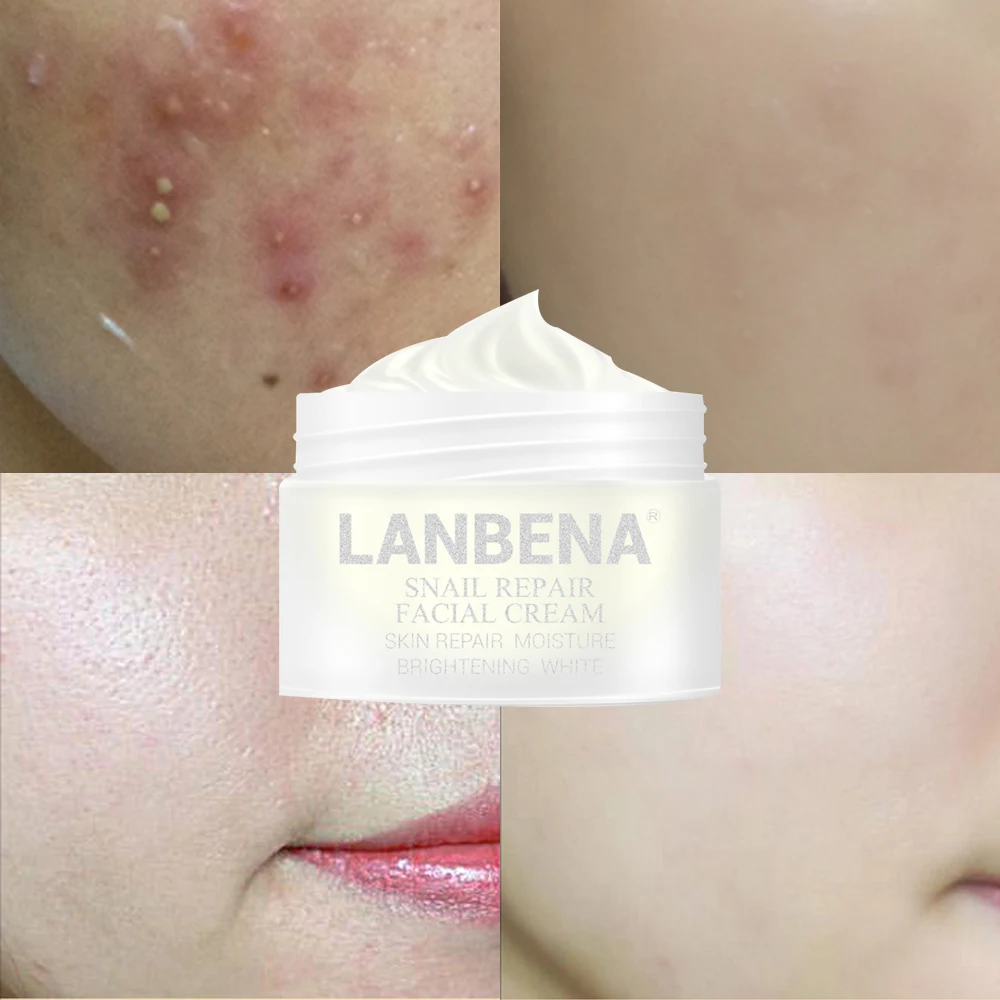 LANBENA удаление акне лечение улитки восстановление и отбеливание крем для лица