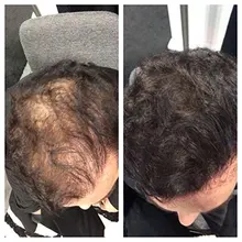 Productos para la pérdida de cabello, Productos naturales sin efectos secundarios para el crecimiento rápido del cabello y el rejuvenecimiento del cabello