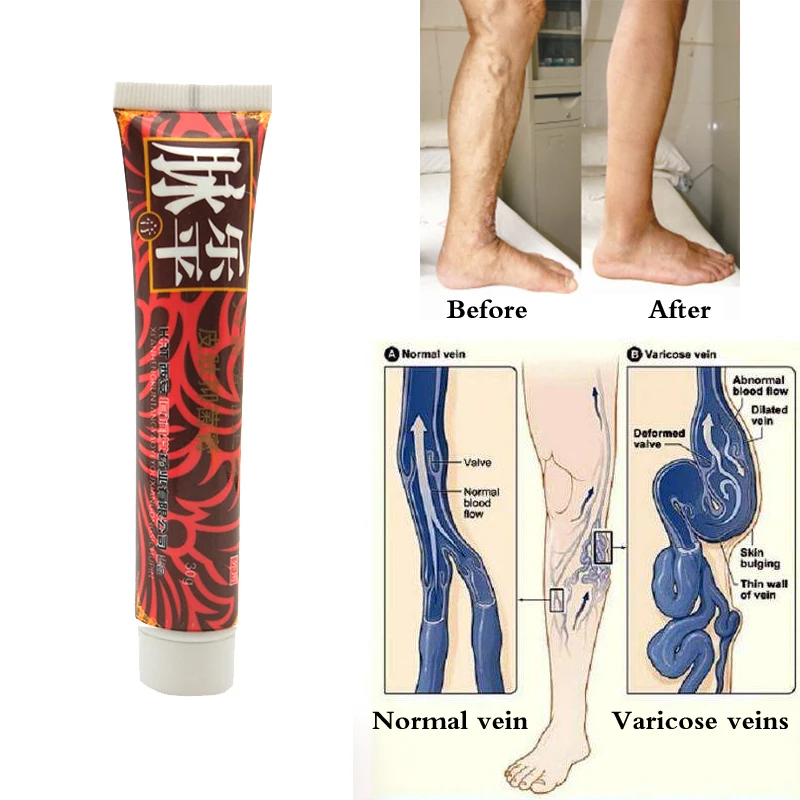 Вены на ногах мазь отзывы. Varicose Veins Ointment от варикоза.