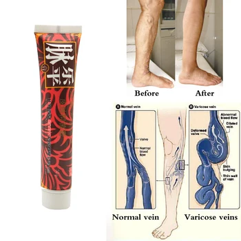 

Varicose Veins Treatment Cream Ointment Vasculitis Phlebitis Spider Veins Pain Varicosity Angiitis Remedy Removal Herbal Cream