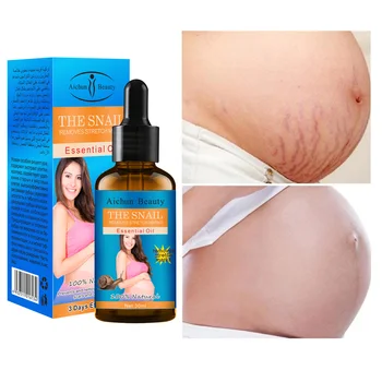 

Snail Removes Stretch Marks Essential Oil Body Repair Cream For Pregnancy Fade Wrinkless Effectively Nourish Skin Care