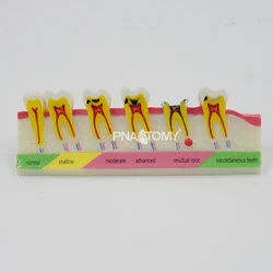 Modèle de démonstration de la carie dentaire et du développement des caries, modèle d'anatomie dentaire, outil pédagogique utilisé par les dentistes 