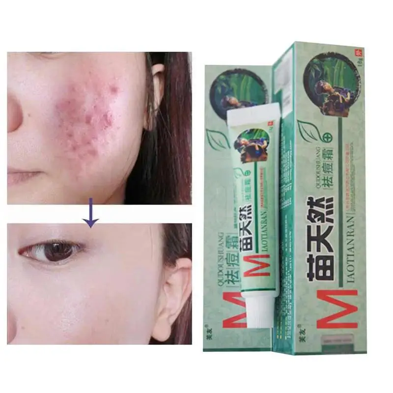 10PCS/lot Original Fuyou Miaotianran remove acne cream germicidal mite and moisturize your skin | Красота и здоровье