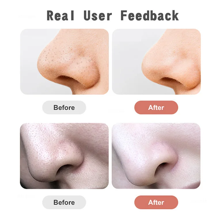 Blackhead Remover Acne Point Noir Black Head Remover Pimples Removal Aspirateur Skin Pore Cleaner Black Dot Beauty Clean Tool