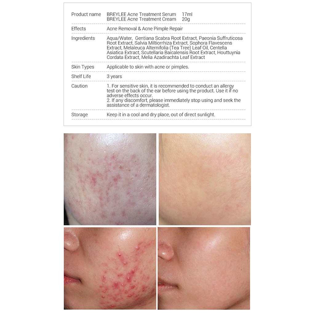 BREYLEE Acne Treatment Face Serum Mask Anti Acne Pimple Scar Remover Moisturizing Whitening Skin Care Facial Essence Cream