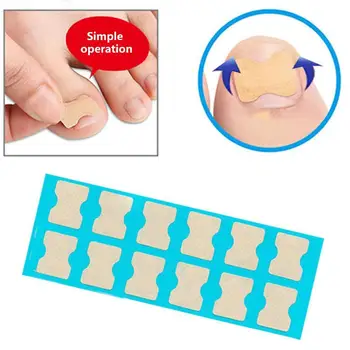 

Ingrown Toenail Correction Sticker Paronychia Treatment Nail Toe Pedicure Foot Tool Care Corrector Fixer Recover Y6D0