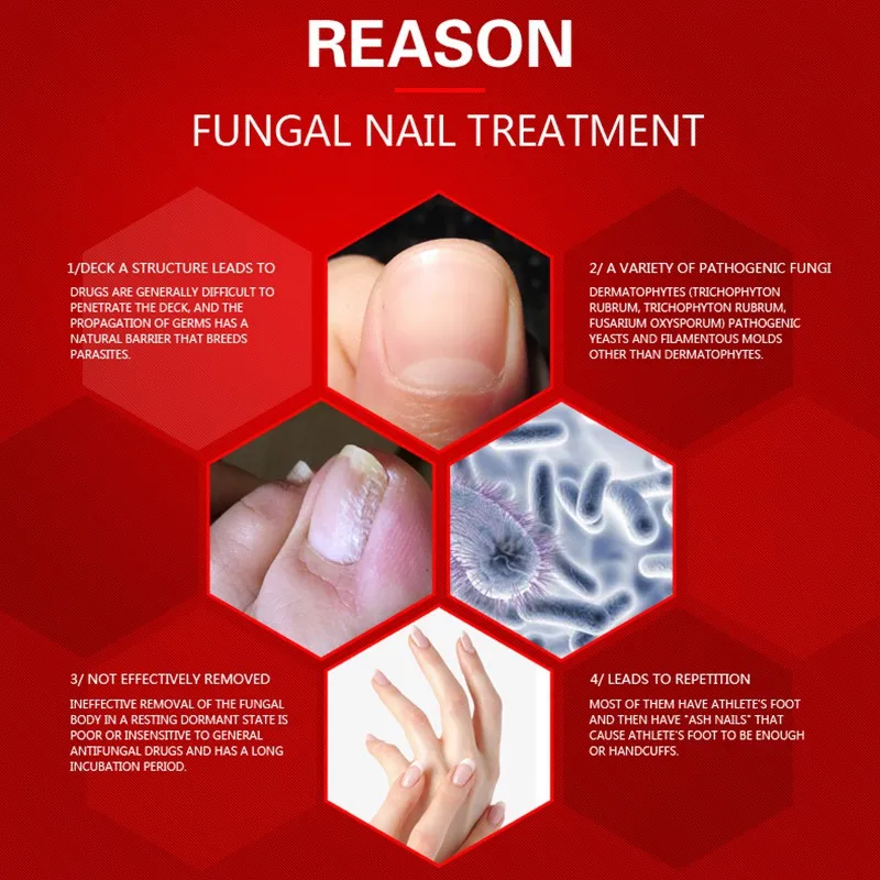 Уход за ногтями Лечение грибка масло онихомикоз Paronychia противогрибковые инфекция ногтей 15 г ремонт ногтей