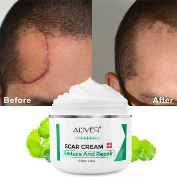 

Advanced Treatment For Face & Body Old & New Scars From Cuts,Stretch Marks,C-Sections & Surgeries Skin Care Scar Removal Cream