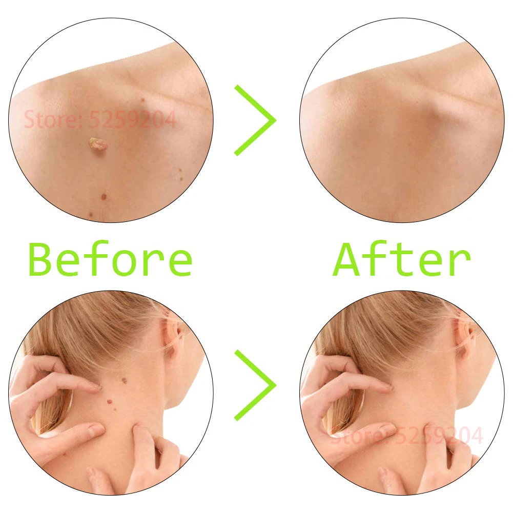 Micro Band Skin Tag Remover Mole Wart Removal For Small to Medium Face Care Pimple Remover Sticker Patch Skin Tag Removal Kit