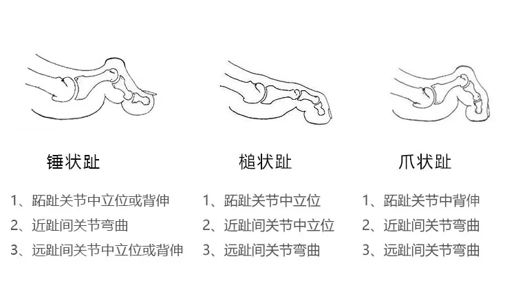 Toe Curved Brace Claw Toe Hammer Hammertoes Two Toes Straightening Transformation Overlap Correction of Hallux Toe Valgus Adult