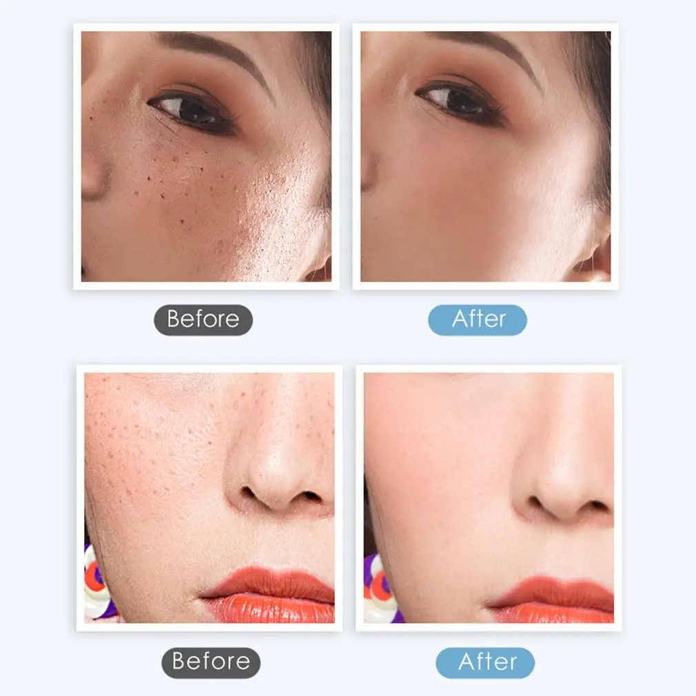 Косметический инструмент для удаления веснушек USB Mini Laser Mole Dark Spot Tattoo Removal LCD ухода