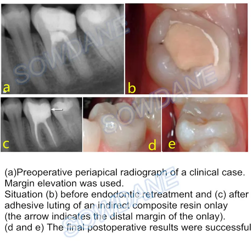 Dental-Tofflemire-Matrix-for-Deep-Margin-Elevation-Large-Curvature-Matrices-Retainer-Sectional-Contoured-Matrice-dental-Material