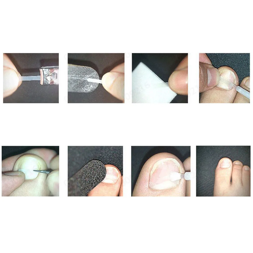 10 шт. ортодонтический Toenail патч для ухода за ногами Paronychia лечение педикюр инструменты ингредиент фиксация силы Уход за ногами пилка для ног