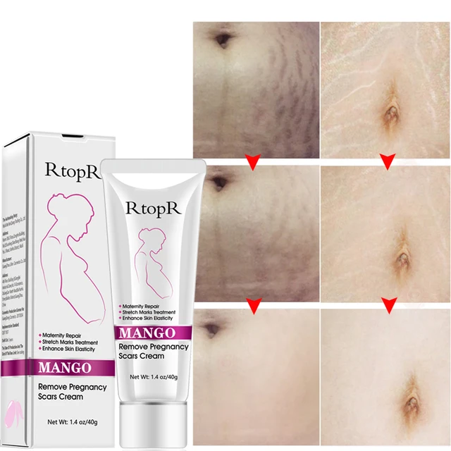 Pregnancy scar removal cream pregnant women pigment correction repair body gel firming and brightening stretch marks