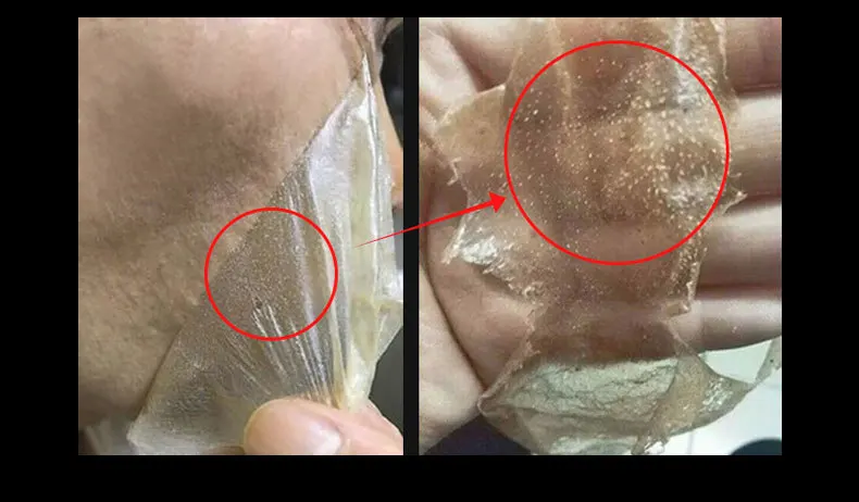 rose-blackhead-removal_10