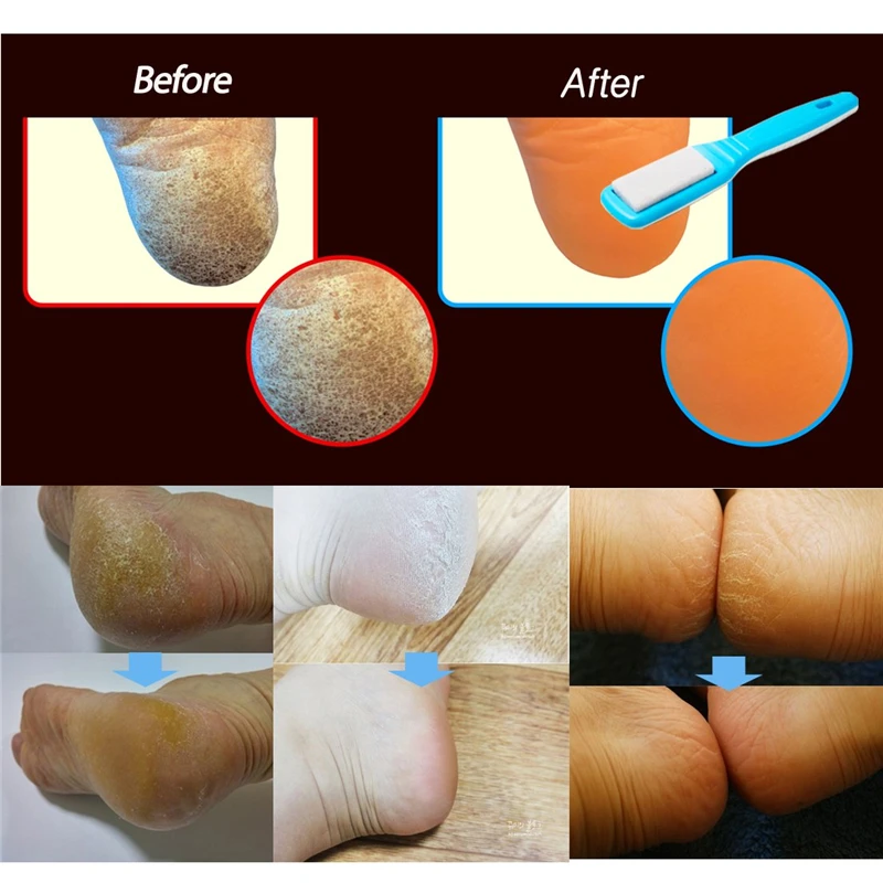 Blue Color Long Handle Foot Care Tool Practical Machine Hard Dry Dead Cuticle Skin Remover Pedicure Care Tool Hot Sale 1PC