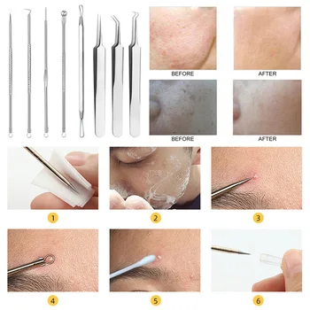 

Blackhead Remover Comedone Extractor Acne Removal Kit For Home Travel Stainless Steel With Storage Case