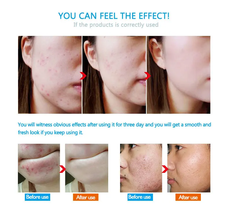 anti-acne_12