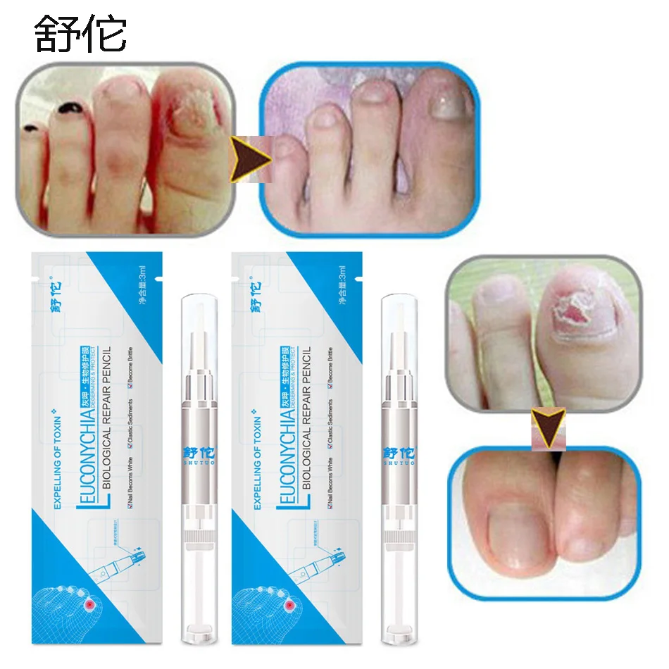 

Perfectly Effectively 2PCS Anti Fungal Treatment Nail Pen 3ML Onychomycosis Paronychia Infection Herbal Toe Finger Nails TSLM1