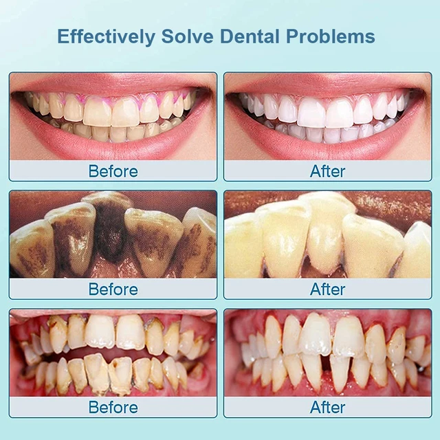 Ablatore dentale Ultra sonico per denti tartaro macchia rimozione del tartaro dei denti elettrico sonic denti detergente per placca rimozione della pietra dentale 5