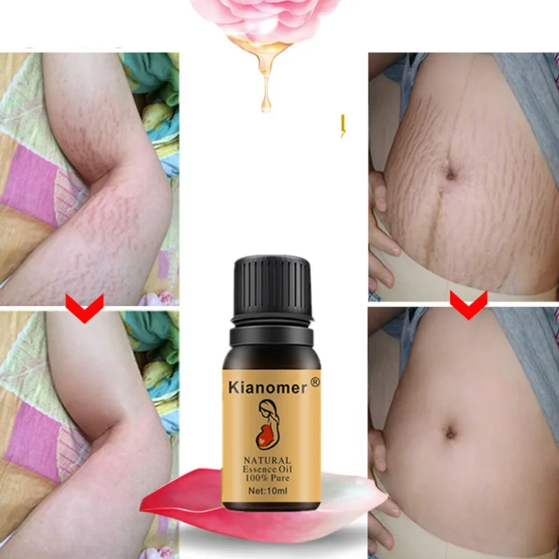 Stretch Marks Repair Essential Oil Nourishing Skin Lightening Pigment Stretch Marks Removal Oil