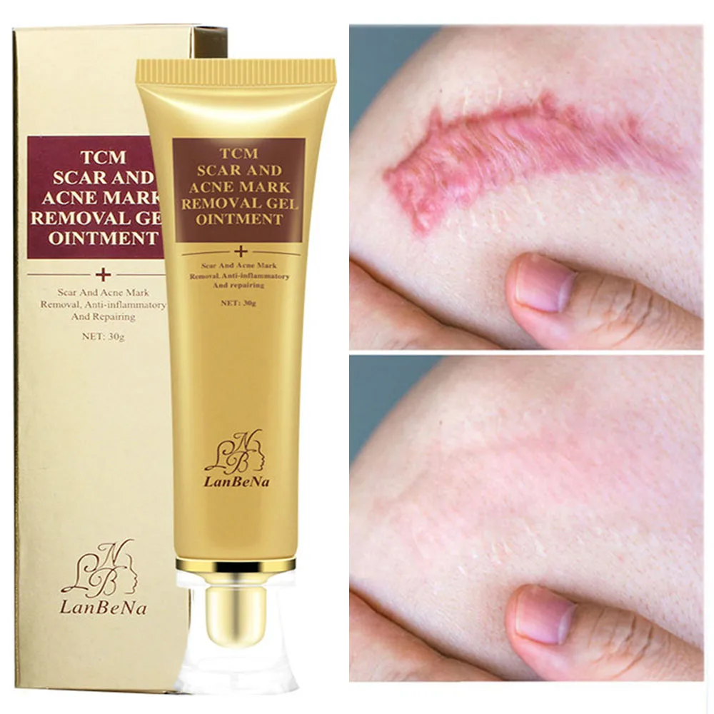 

LANBENA Acne Scar Removal Face Cream Remove Acne Spots Acne Gel Repair Stretch Marks Pigmentation Corrector Whitening Cream 30ml