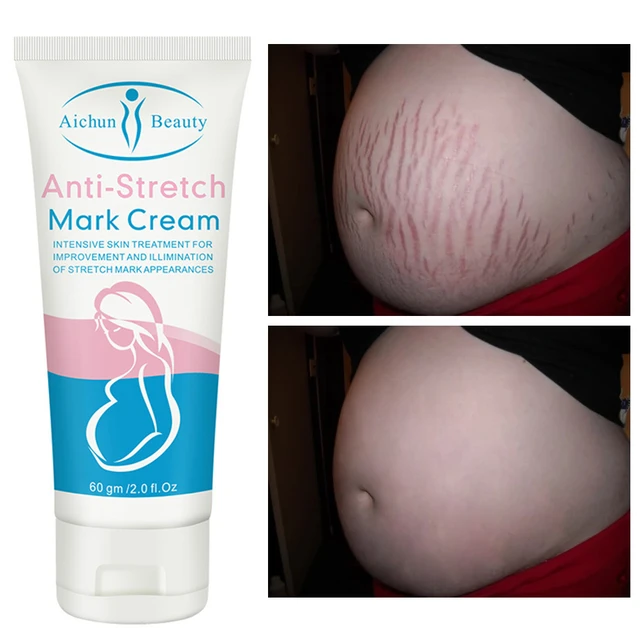 Anti-Stretch Mark Cream Remove Stretch Marks Moisturizing Nourishing Remove  Cellulite Improve Rough Brighten Skin Tone Skin Care - AliExpress