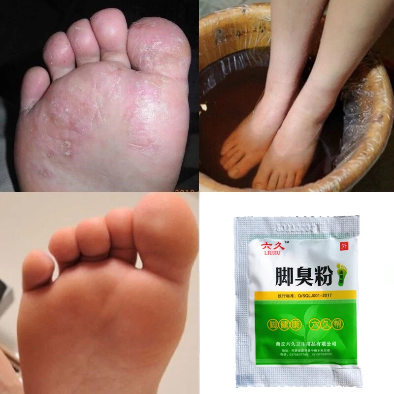 10Pcs Foot Deodorant Powder Antiperspirant Bad Smell Removal Cure Psoriasis Professional Antibacterial | Красота и здоровье