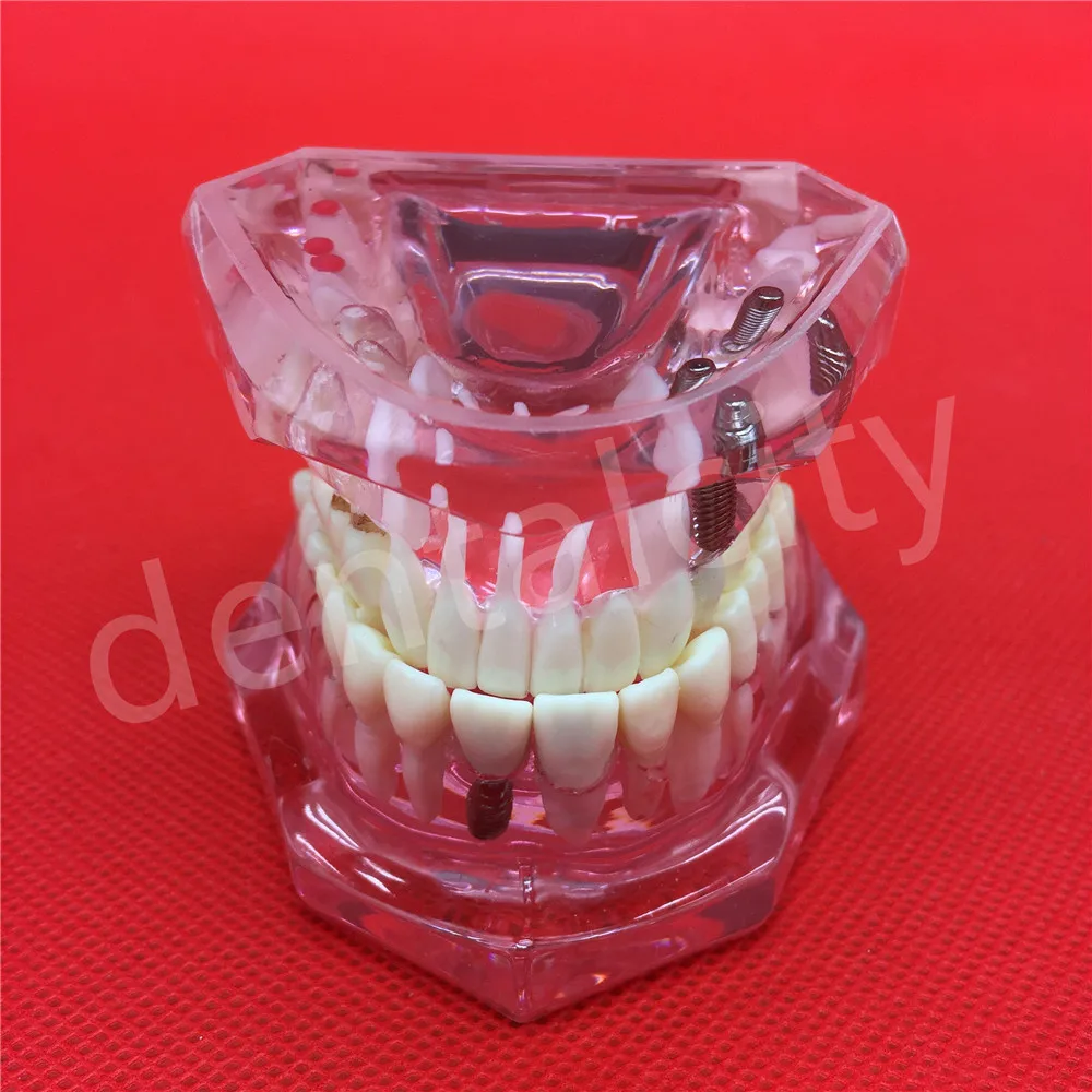 Новая модель зубного импланта с реставрационным мостом для протеза|teeth model|dental