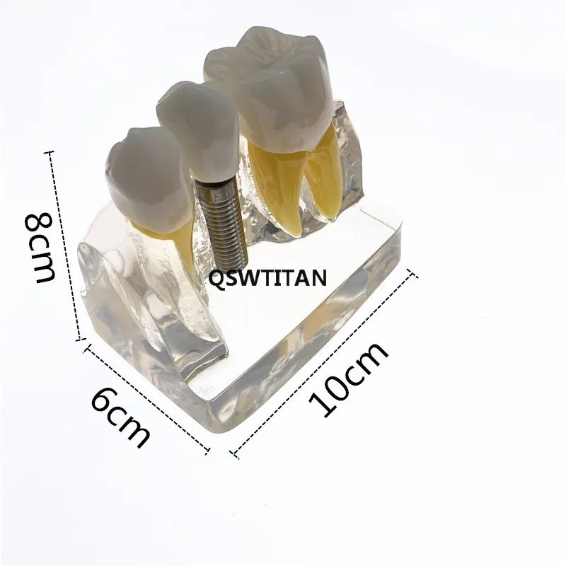 análise de coroa, ponte removível, modelo de dentes de demonstração dental