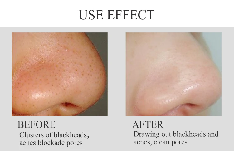 treading products electric blackhead removal skin care device